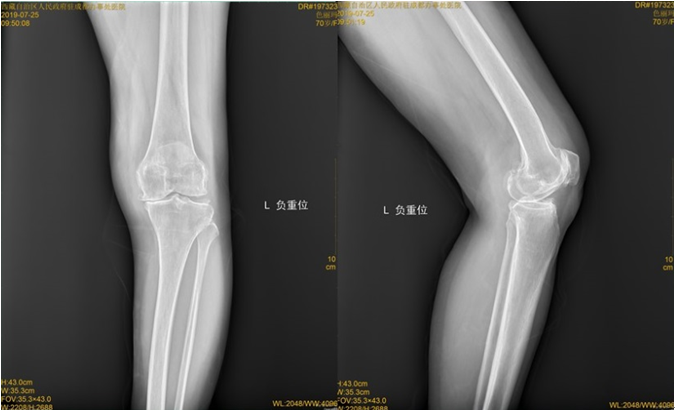 术前X光显示：骨质增生，关节狭窄，内翻畸形.png