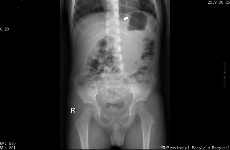 紧急透视检查发现失踪的2颗磁力珠在胃贲门处。.jpg