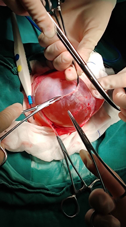 畸胎瘤腹腔镜手术图片